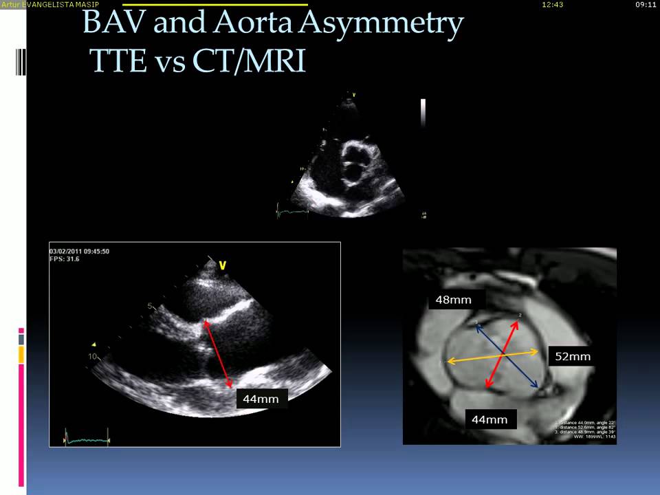 Echocardiographic assessment of bicuspid aortic valve