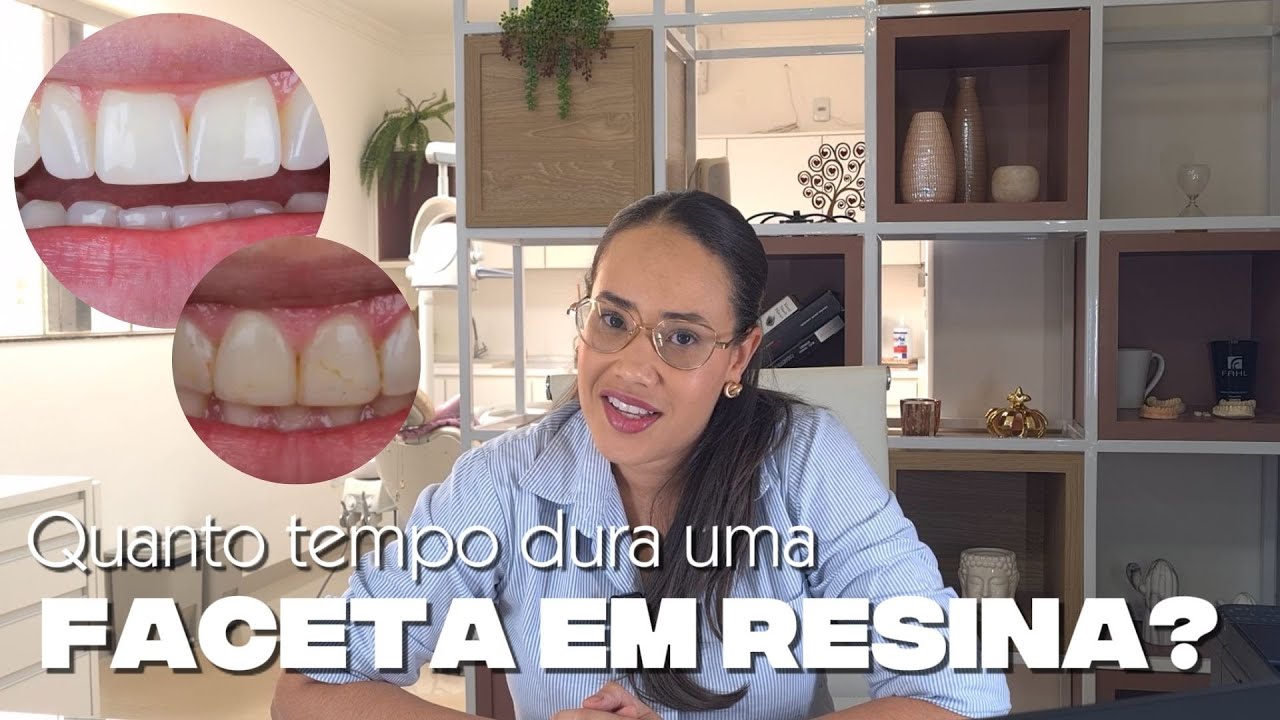 QUANTO TEMPO DURA UMA FACETA EM RESINA COMPOSTA? | Dentística Descomplicada