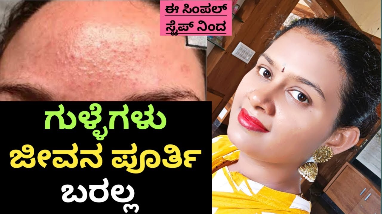 ರಾತ್ರಿ ಮಲಗುವಾಗ ಇದನ್ನು ಹಚ್ಚಿ, ಮತ್ತೆ ಯಾವತ್ತು ಸಣ್ಣ ಮತ್ತು ದೊಡ್ಡ ಗುಳ್ಳೆಗಳು ಬರುವುದಿಲ್ಲ| NO MORE TINY BUMPS