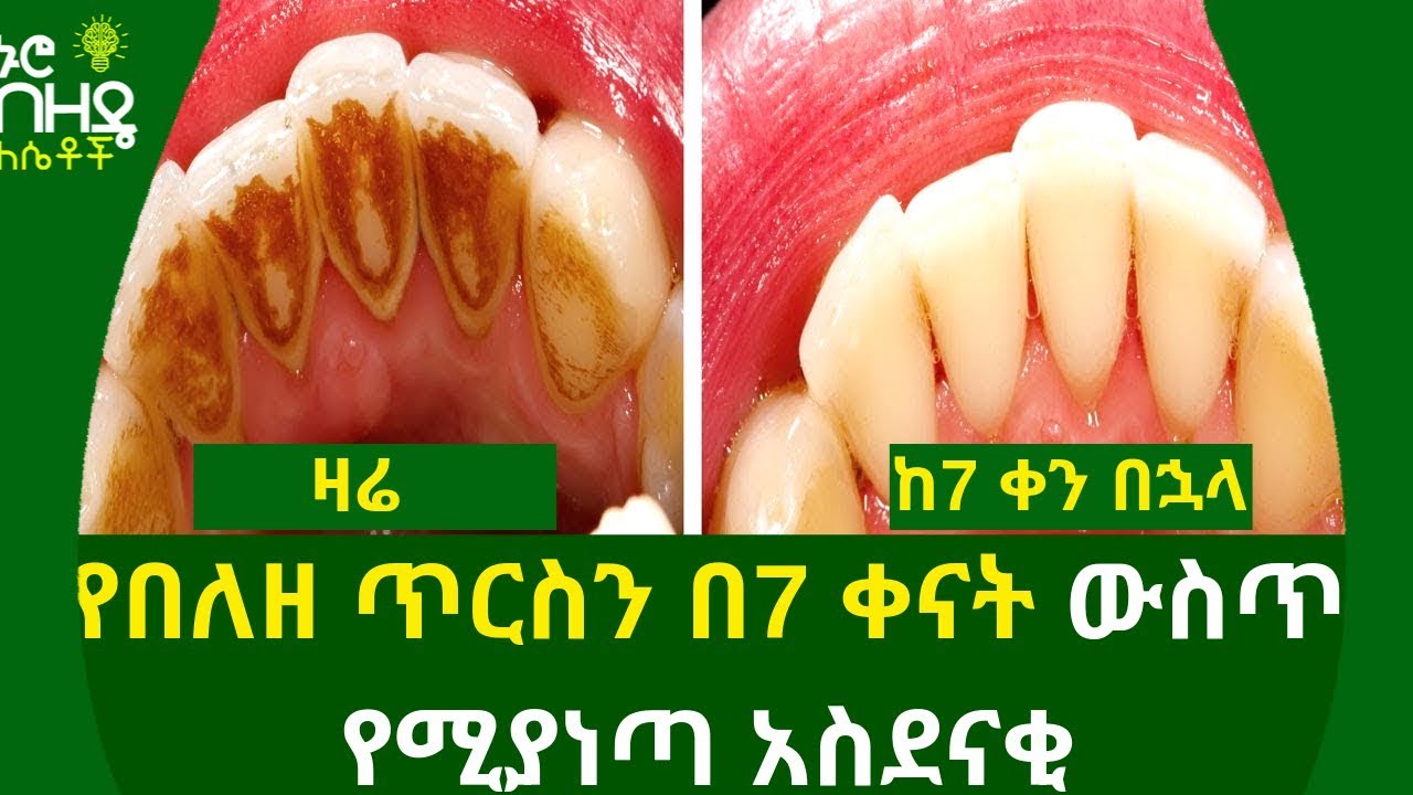 Ethiopia:- የበለዘ ጥርስን በ7 ቀናት ውስጥ የሚያነጣ አስደናቂ ውህድ | Nuro Bezede Girls