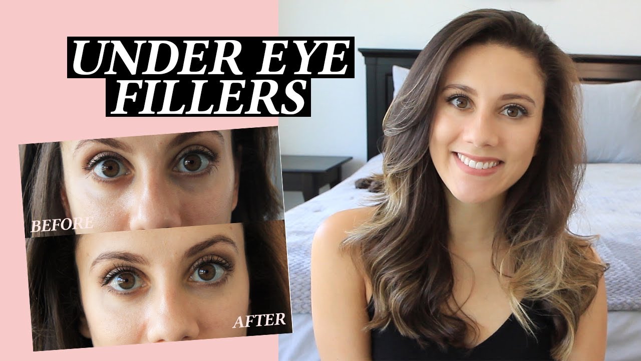 Under Eye Injections: My Facial Fillers Experience, Cost, Before and After