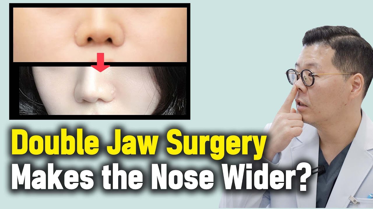 [EN/JP] Double Jaw Surgery changes the shape of nose? no way! Click to check the facts.
