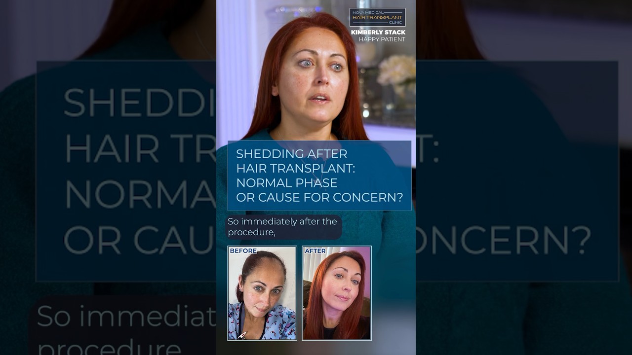 🙌🏻Kimberly&rsquo;s Shedding Phase: A Journey of Patience. Part 1 / #hairtransplantsforwomen #fuehair