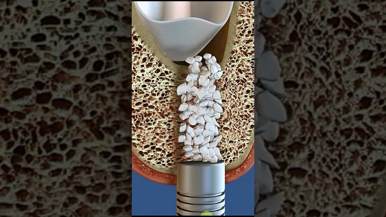Sinus lift and implant placement #shorts