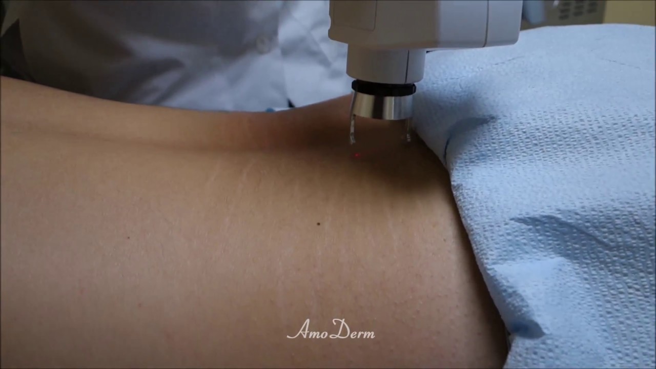 Treatment of Stretch Marks with Fractional CO2 Laser by Amoderm