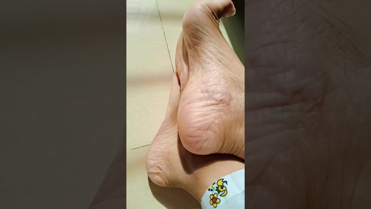 Cracked heels 