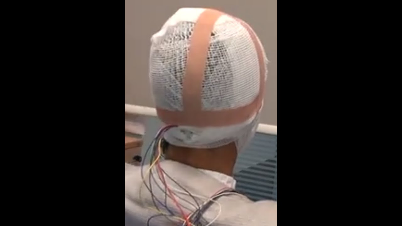 Collodion-free EEG electrode application for Home Video EEG at Evelina London Children's Hospital