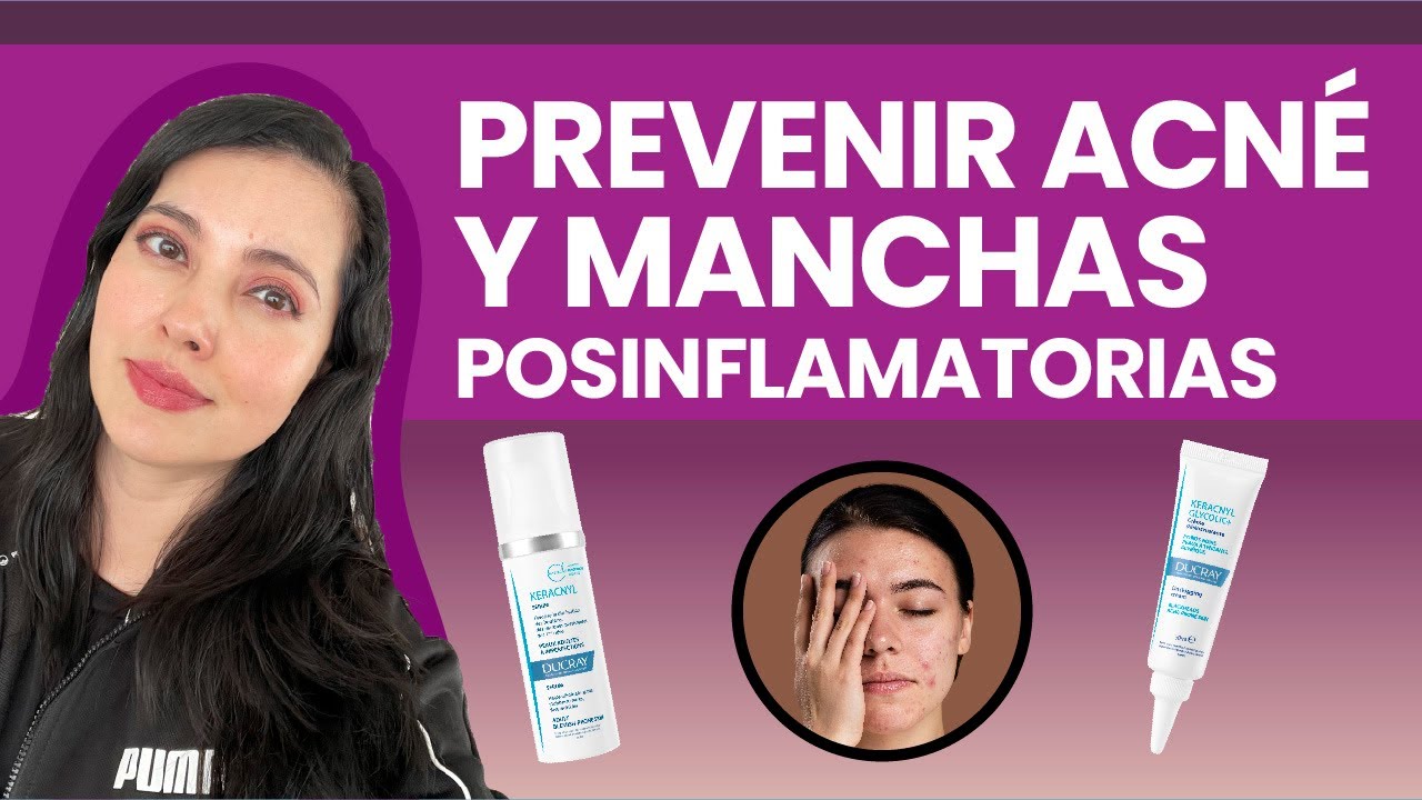 COMO MEJORAR ACNÉ Y MANCHAS 👩🏻‍⚕️Reseña KERACNYL GLYCOLIC Y SERUM