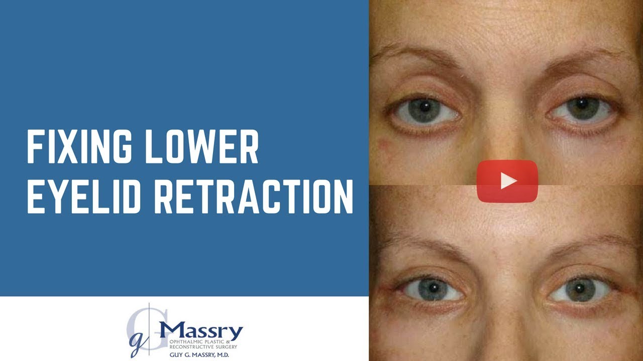 Fixing Lower Eyelid Retraction | Dr Guy Massry