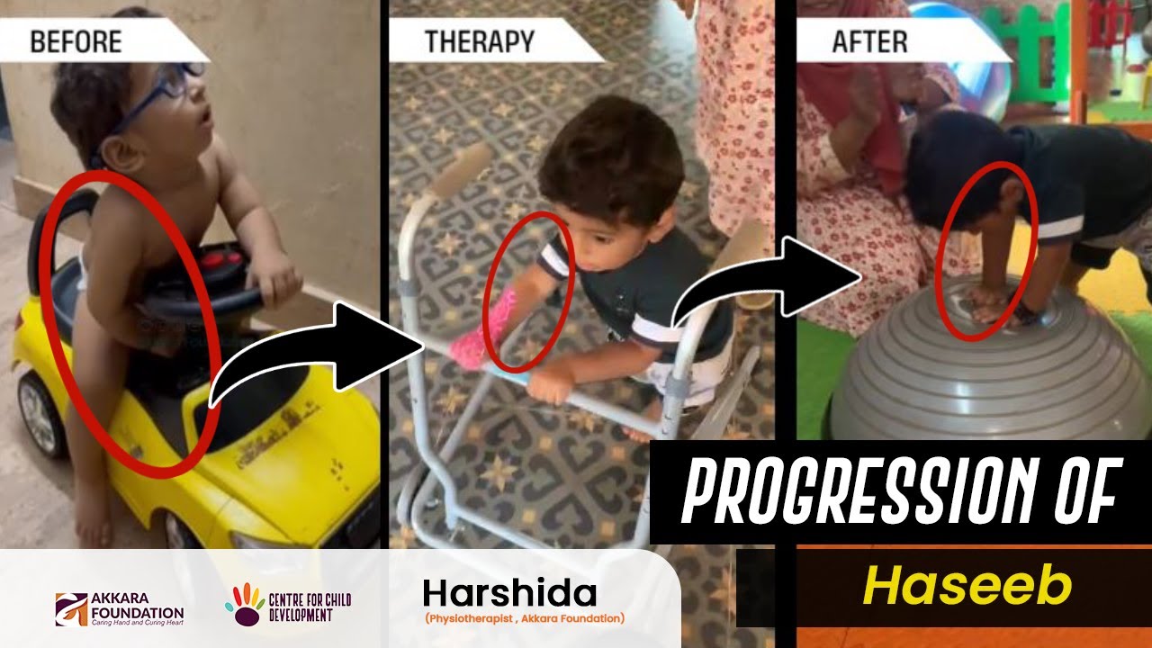 Recovery stages of Haseeb with Pediatric Stroke- Hemiparesis after 1year of continuous Physiotherapy