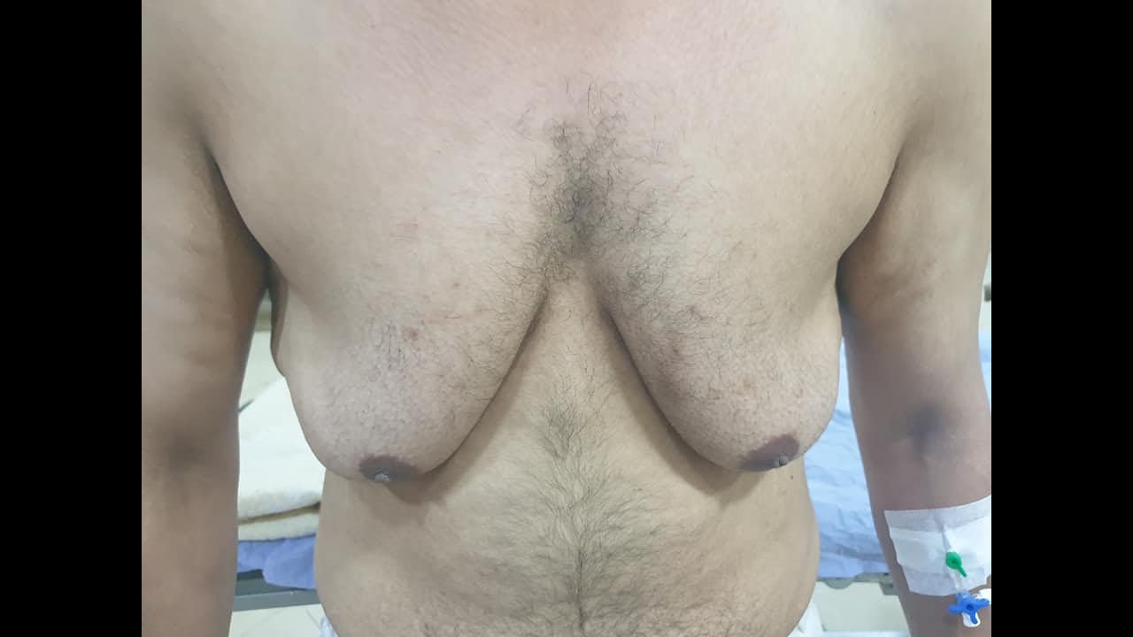 التثدى عند الرجال