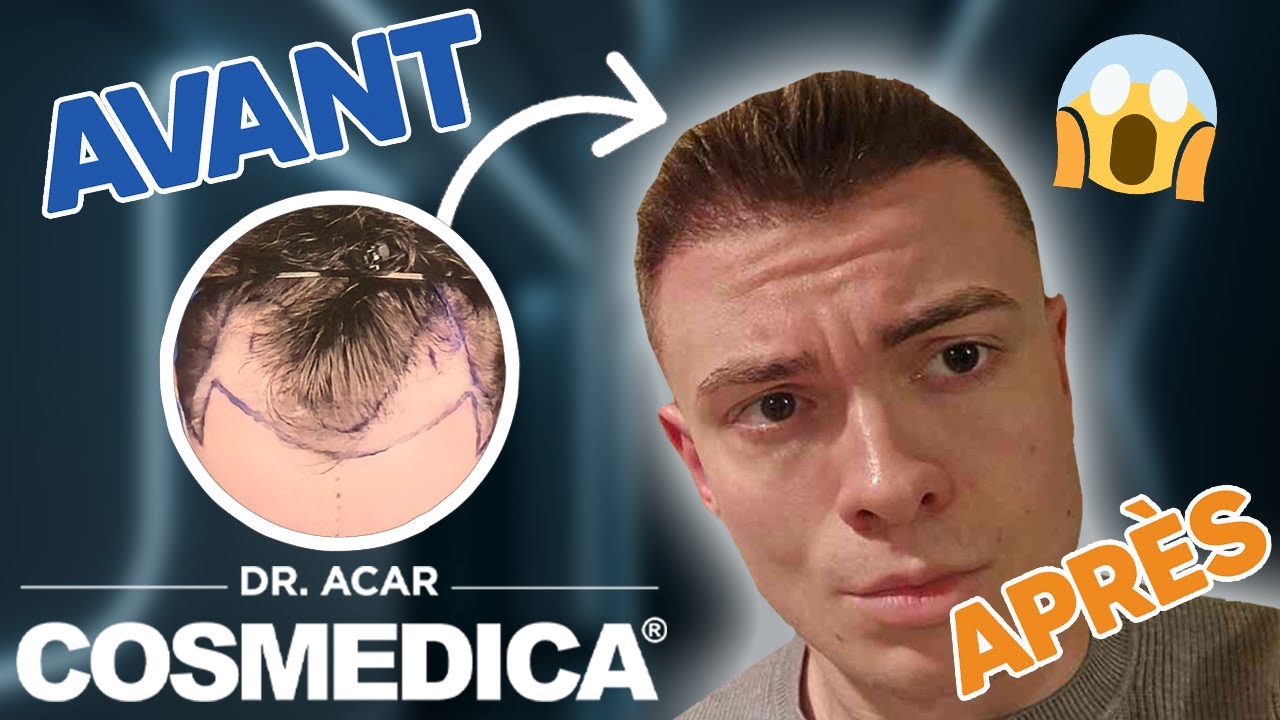 COSMEDICA Dr. Acar – Greffe de cheveux Turquie | Mois 4 :  Des résultats prometteurs