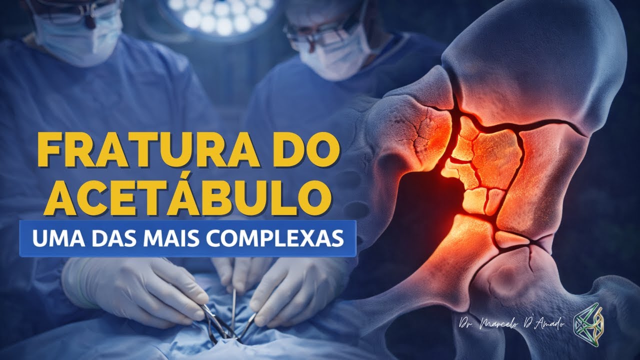 Fratura do Acetábulo: Quando é Grave e Precisa de Cirurgia? | Ortopedia em 5 Minutos