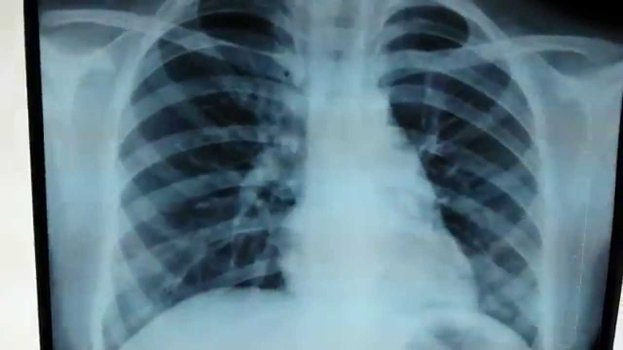Same patient xx with right lower lobe consolidation