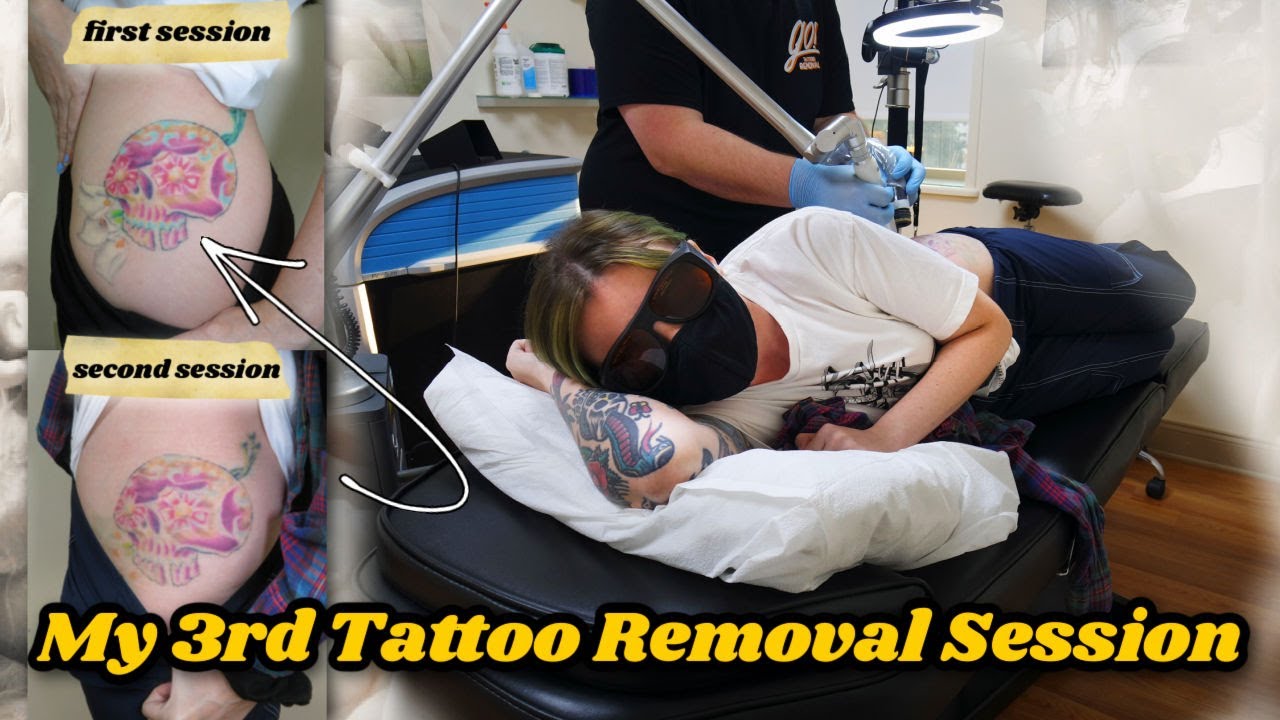 My Third Tattoo Removal Session: Potentially my last!