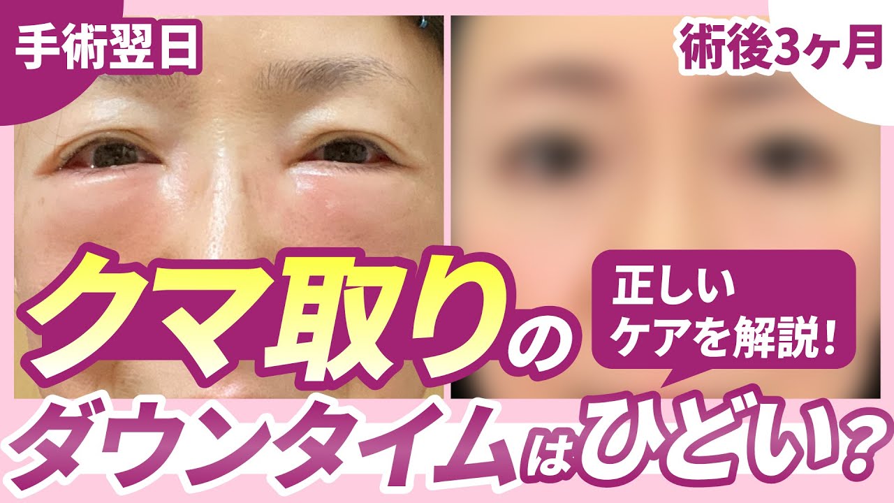 【必見】クマ取りのダウンタイムはひどい？実際の症例と正しい術後ケアを解説！【裏ハムラ/脱脂】