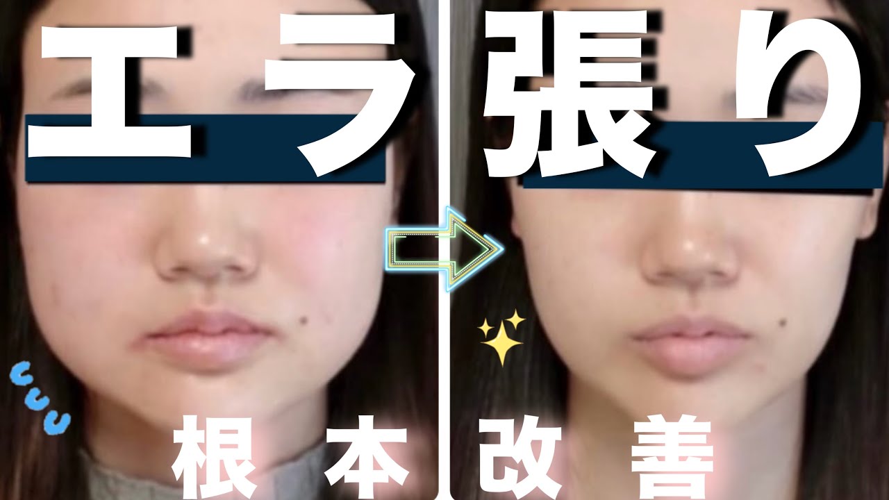 【衝撃変化】エラ張りこれ１週間やったら写真での変化やばいってお話