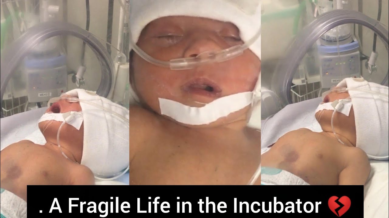 A fragile soul inside the incubator… please keep in your prayers 🙏