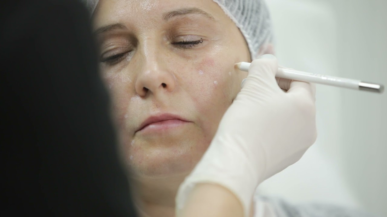 RRS HA Long Lasting - biorevitalizare și volumetrie facială
