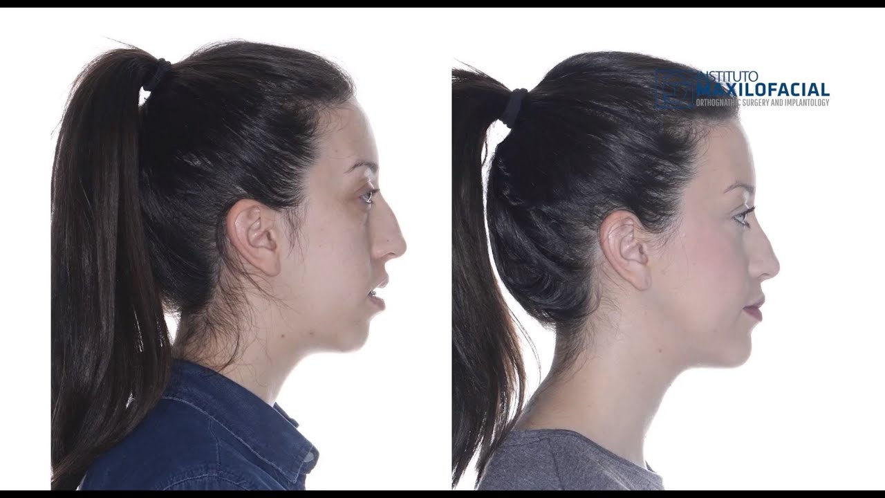 Cirugía ortognática bimaxilar. Rinoplastia. Caso #50: Jessica - Clase 2, biretrusión