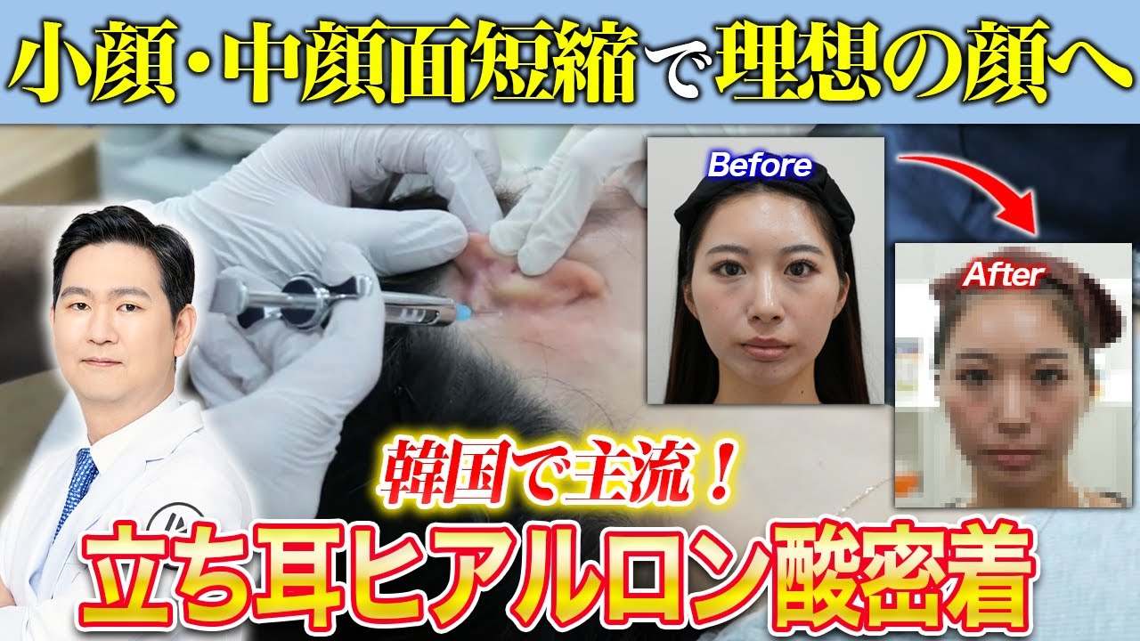 【施術密着】立ち耳で小顔効果アップ？韓国で人気の立ち耳ヒアルロン酸施術に密着