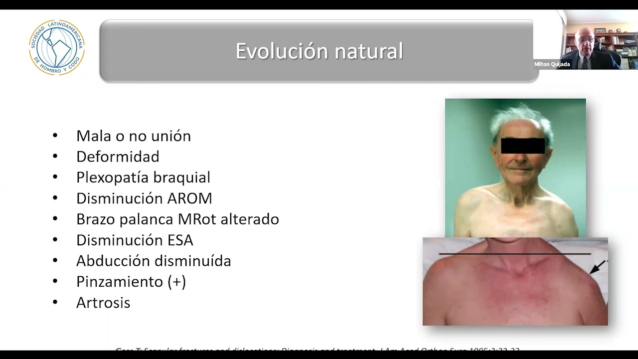 Definición y manejo de lesiones del Complejo Suspensorio Superior del Hombro. Dr  Milton Quijada