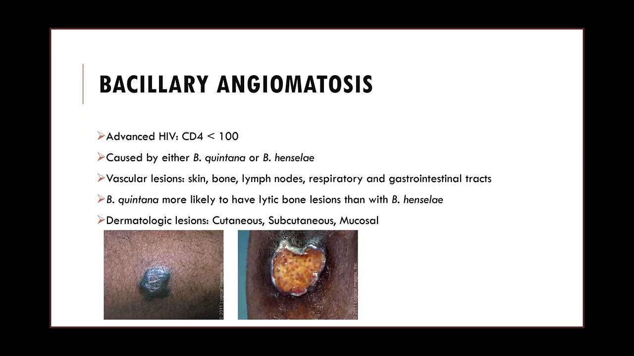 Bartonella Infections - Tyral Ramsamy
