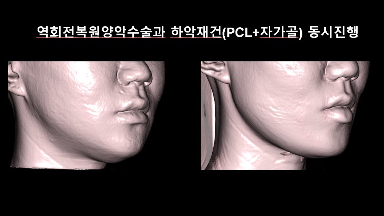 역회전양악수술과 하악재건(PCL+자가골) 동시진행  Simultaneous revision 2 jaw op and mandibular reconstruction using PCL