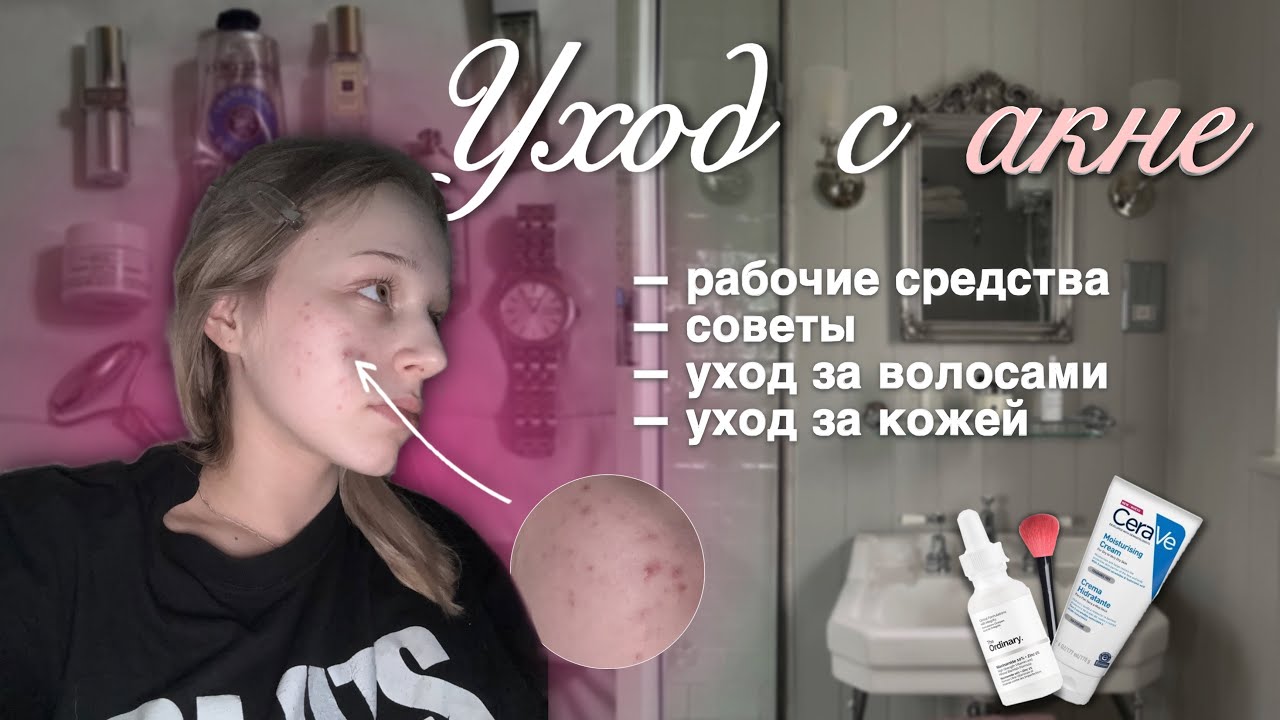 жизнь с акне, советы,уход и продукты (волосы,кожа, тело)