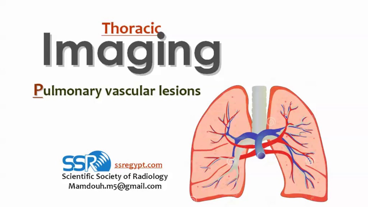 7 Pulmonary Vascular lesions - prof.Mamdouh Mahfouz (2019 edition)