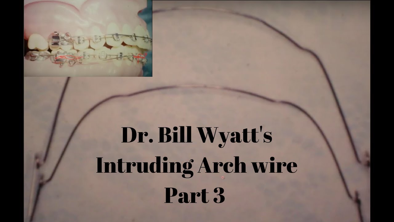 Dr. Bill Wyatt Intruding Arch wires: Intruding arch with reverse torque (3 of 6)