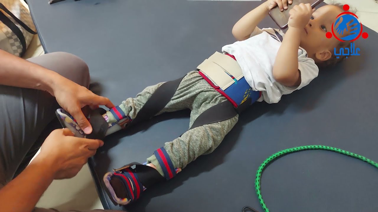 Trial of Twister strap orthosis | تجربة شريط تعديل التفاف الطرف السفلي