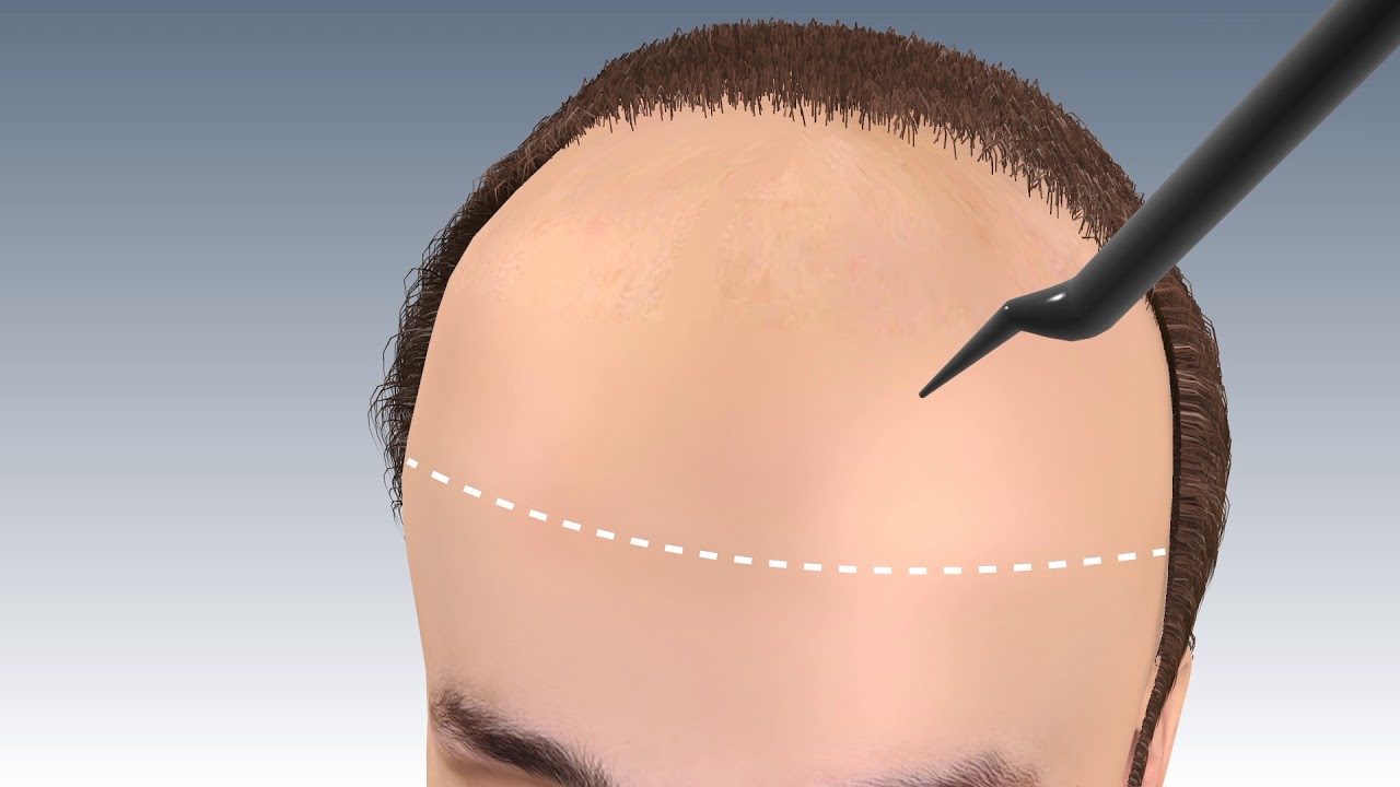 Step by Step FUE Hair Transplant Surgery in jaipur | Hair transplant in india | Outbloom clinics