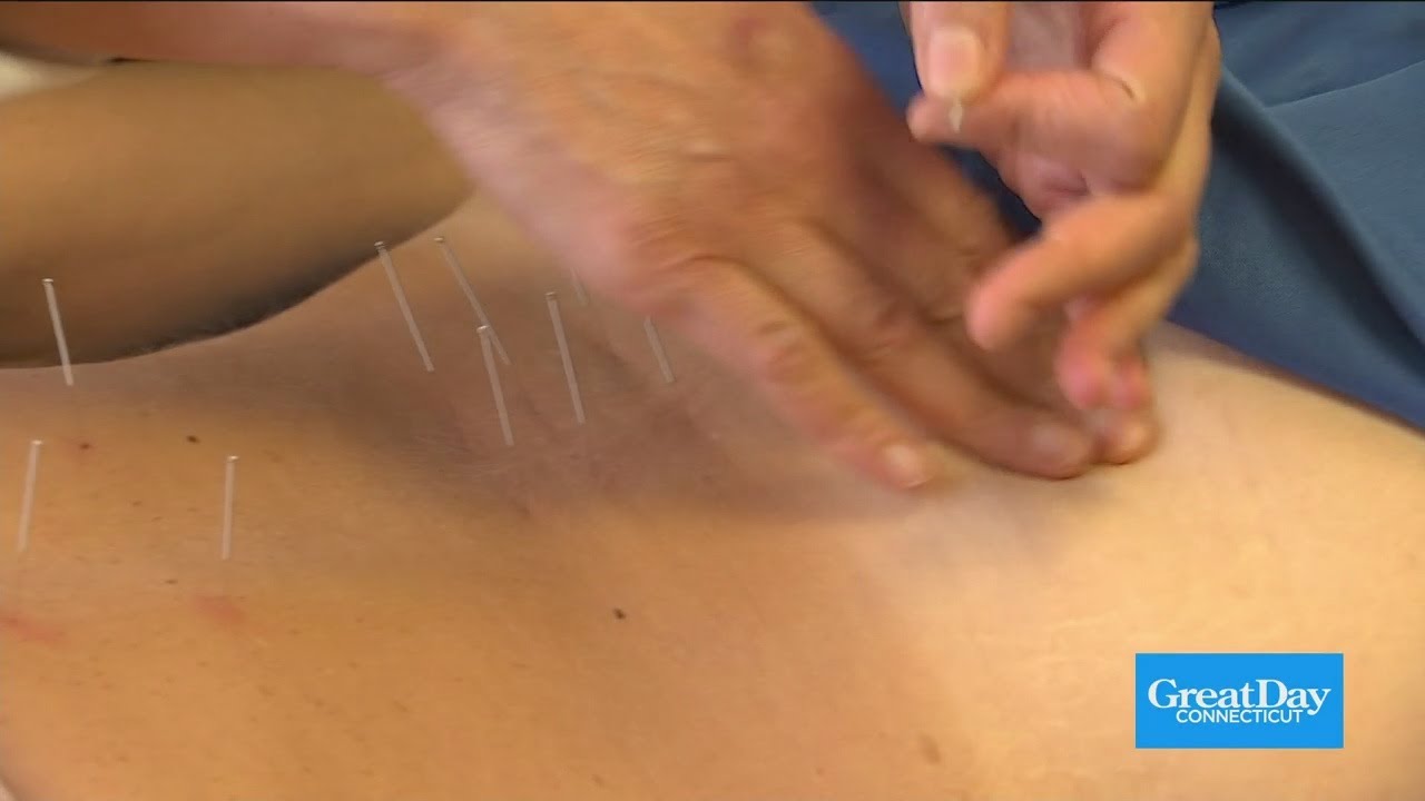 Benefits of Acupuncture