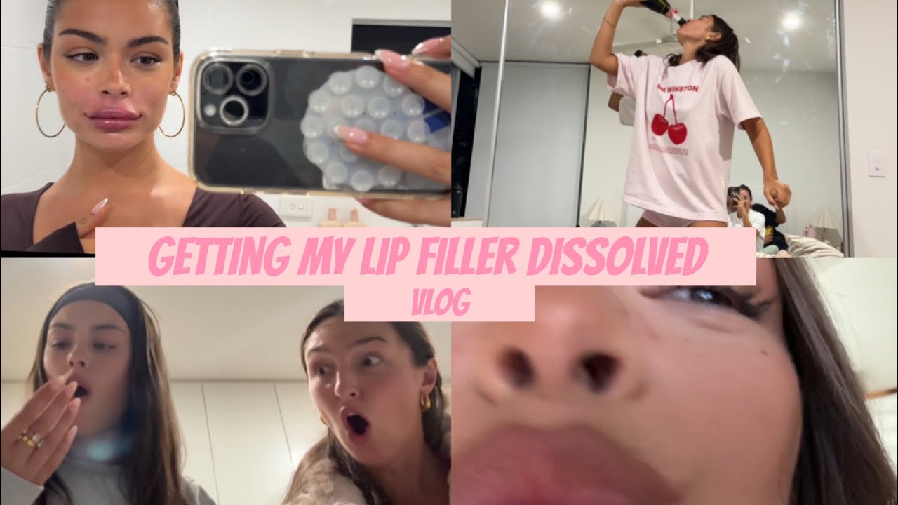 LIP FILLER DISSOLVED & cyclone lockdown vlog