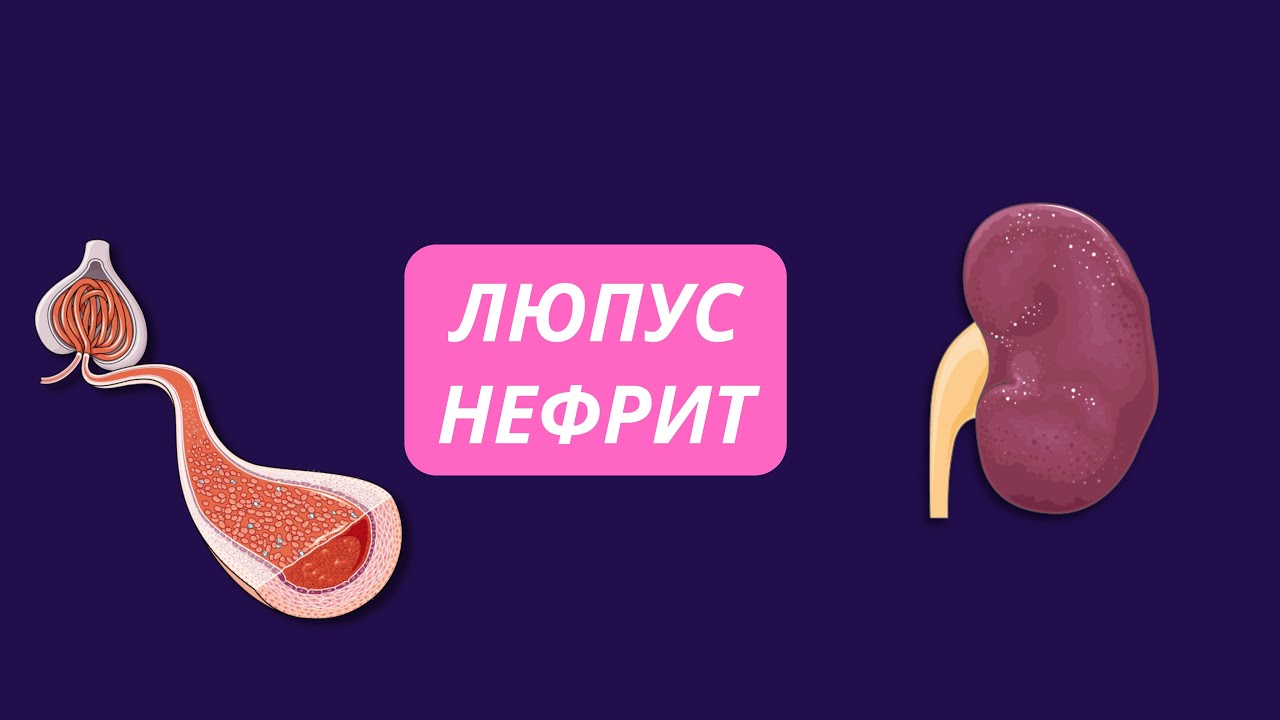 Люпус (волчаночный) нефрит, патофизиология, диагностика, лечение