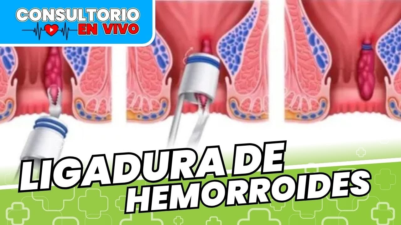 ¿Cómo se tratan las HEMORROIDES sin CIRUGÍA? La ligadura con bandas elásticas | CONSULTORIO EN VIVO