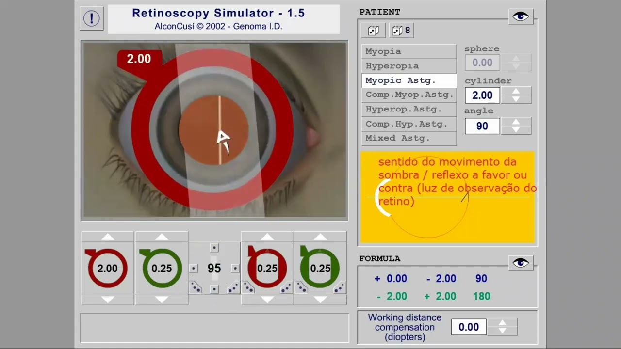 VÍDEO #2 - Retinoscopia técnica por esferas