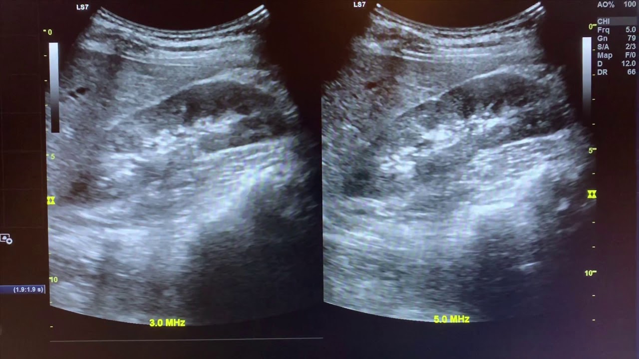 Attenuation & Interactions with Ultrasound