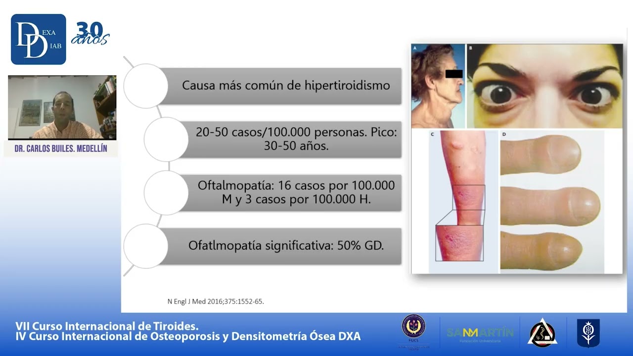 1. Conferencia del Dr. Carlos Builes sobre hipertiroidismo