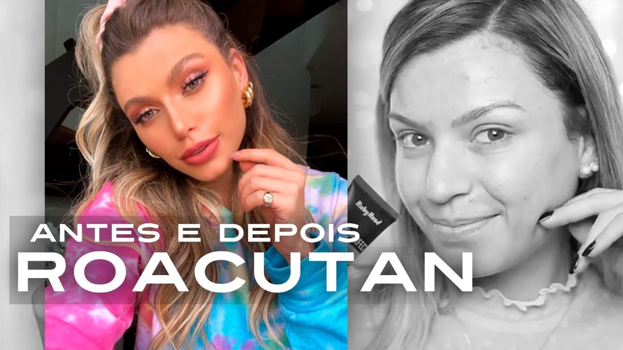 Minha experi&ecirc;ncia com Roacutan - Mam&aacute; Castilho