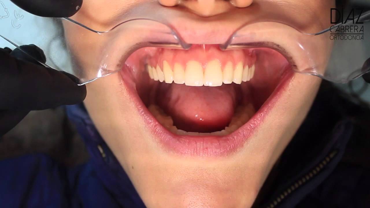 2 Tips para Fotografía Clínica en Odontología