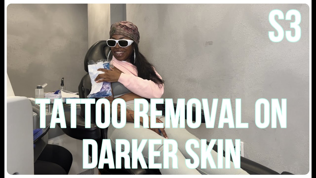 Tattoo Removal on Darker Skin S3!