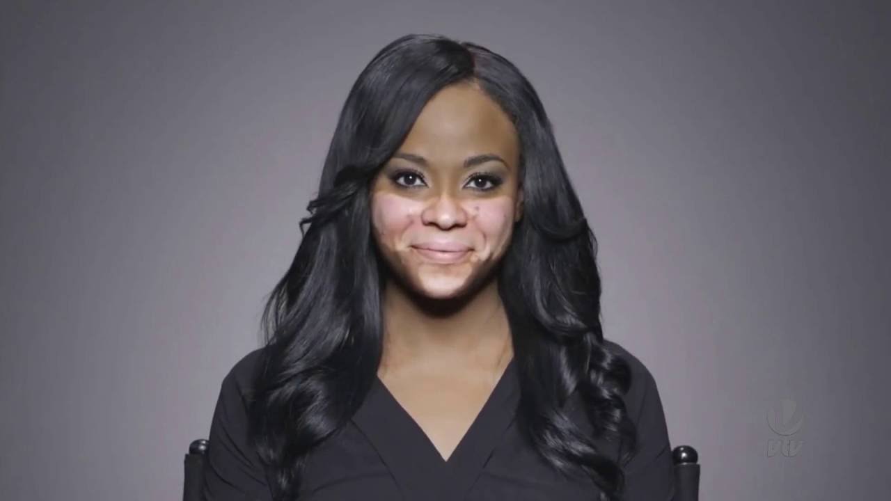 Dermatologista fala sobre tratamentos para vitiligo
