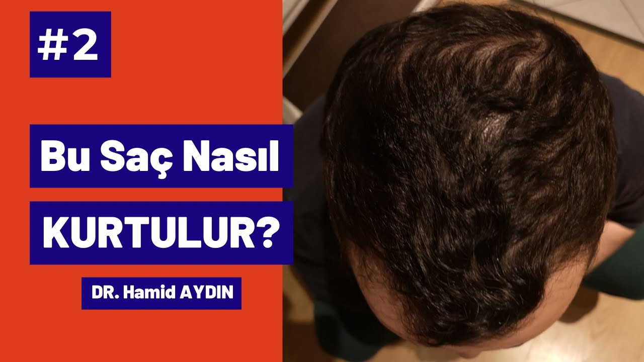 Bu Saç Nasıl Kurtulur? #2 Dr. Hamid AYDIN