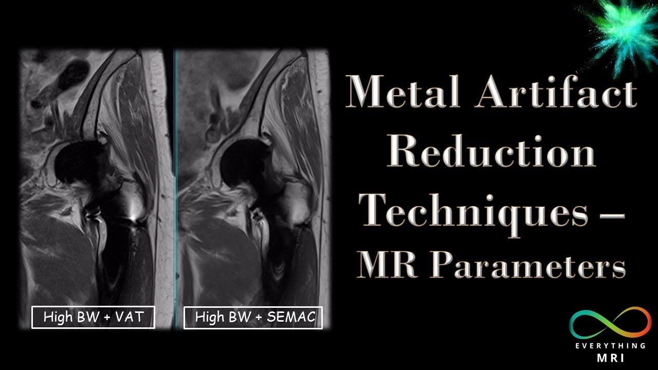 Metal Artifact Reduction Techniques - MR Parameters