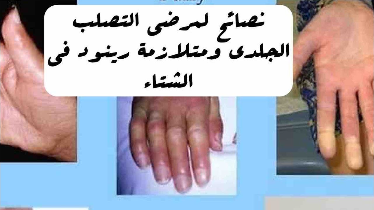 نصائح لمرضى التصلب الجلدي ومتلازمة رينود