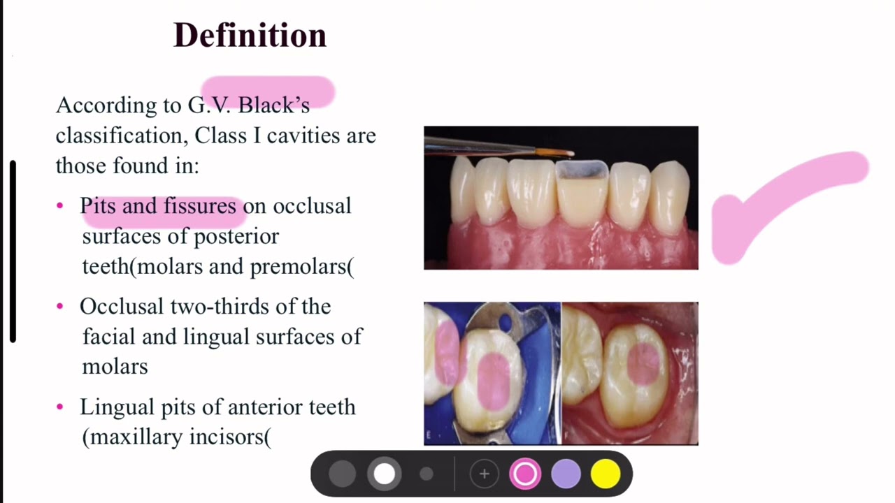 Class I cavity preparation المحاضرة الثالثة عشر من كورس الحشوات