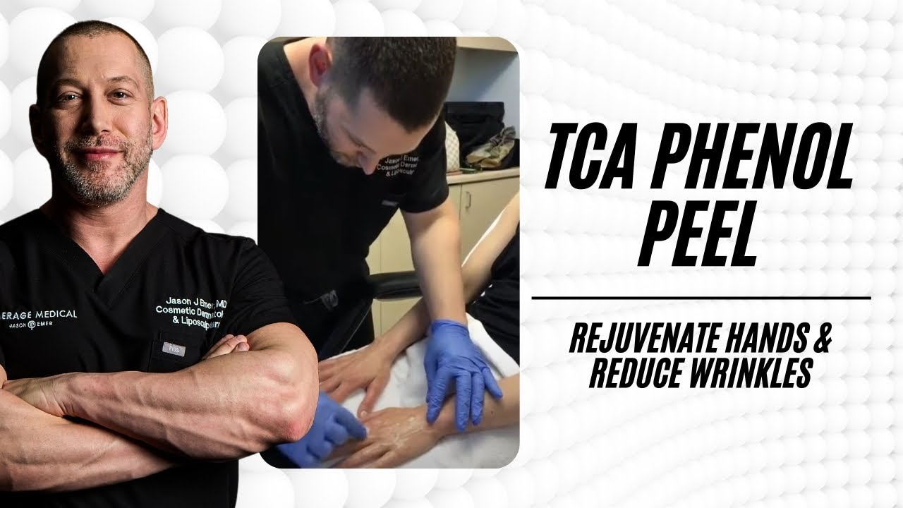 TCA PHENOL CHEMICAL PEEL FOR HAND WRINKLE AND SUN DAMAGE REJUVENATION | DR JASON EMER
