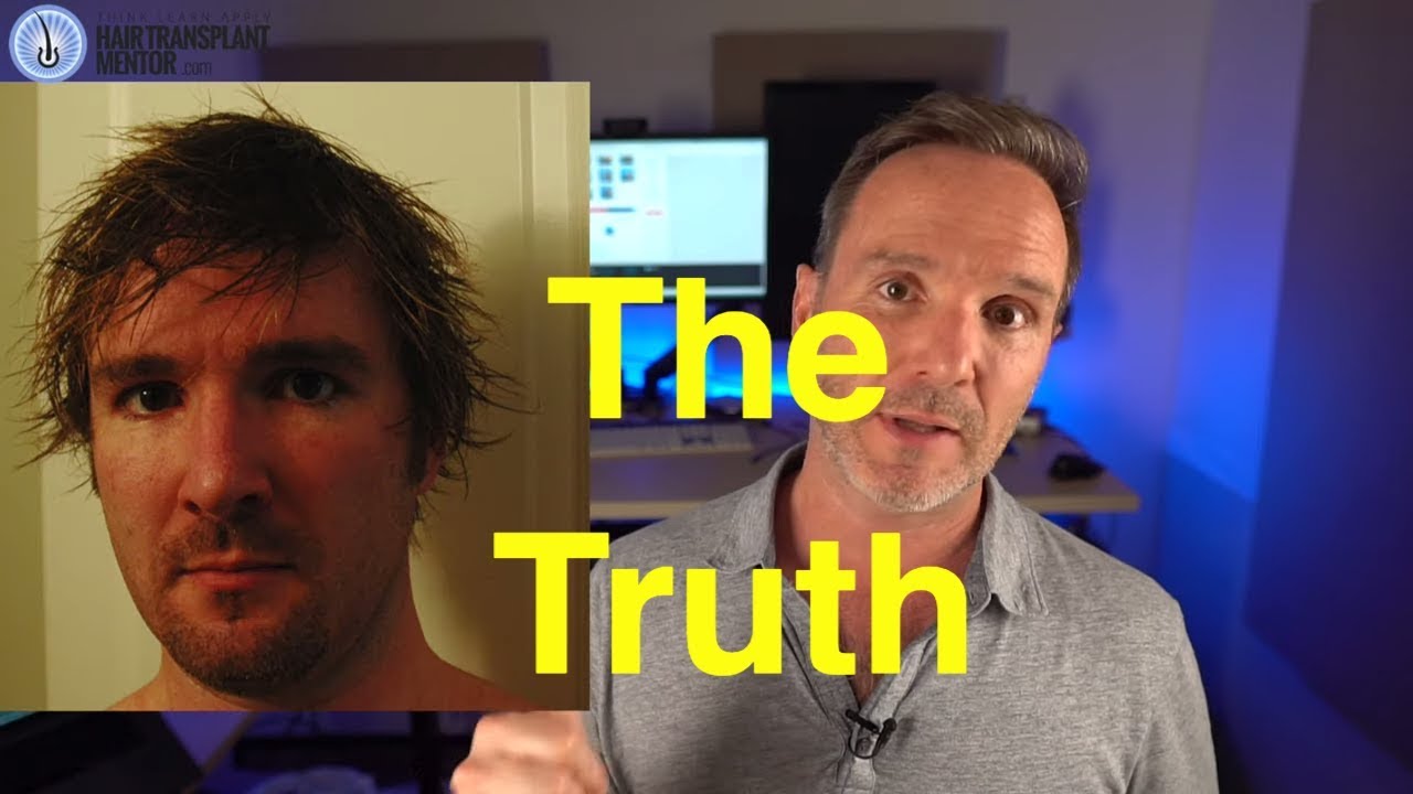 My 9 Hair Transplants -  The Truth